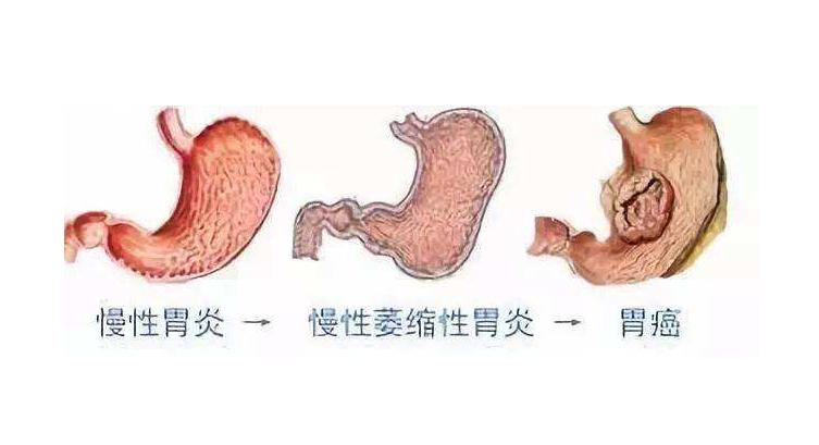 肠息肉癌前病变有哪些症状,肠粘膜癌有什么症状