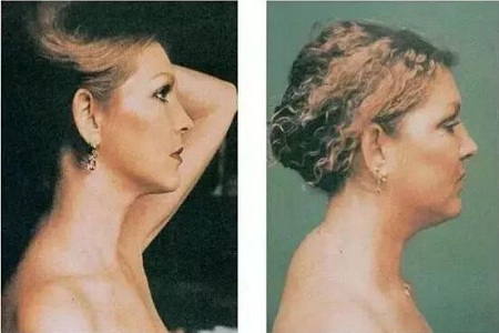 颈椎富贵包怎么做操可以缓解,颈椎突出一个包怎么快速恢复