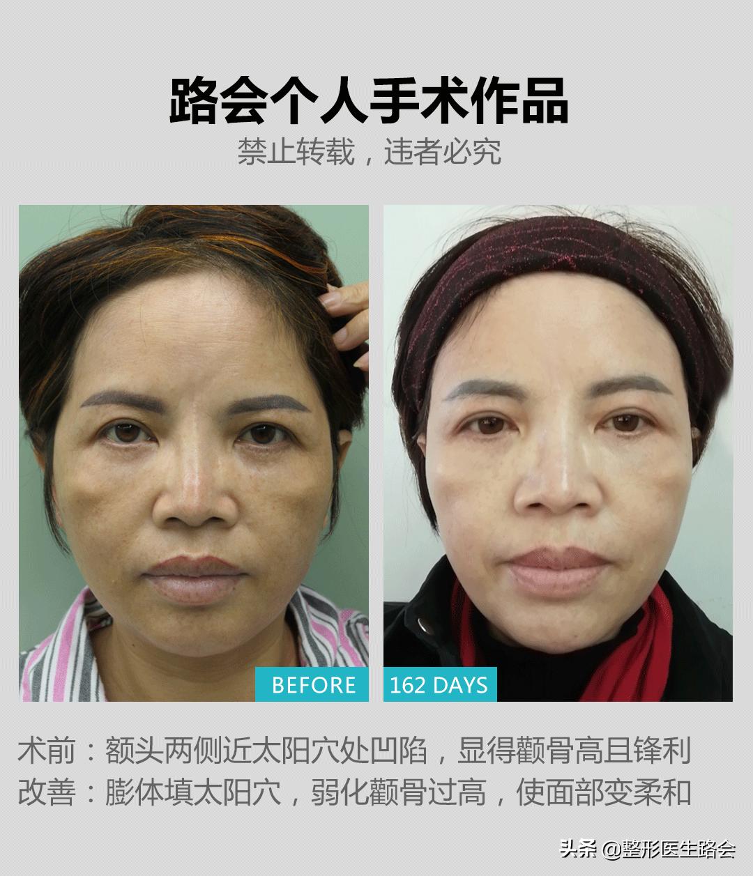 颧骨高真的能通过手法改善吗,颧骨高怎么样才可以改善