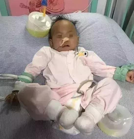 儿童小肠切除5厘米,小孩子小肠切除70公分严重吗