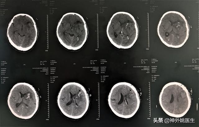 球囊扩张血肿怎么办,经皮穿刺脑血管腔内球囊成形术