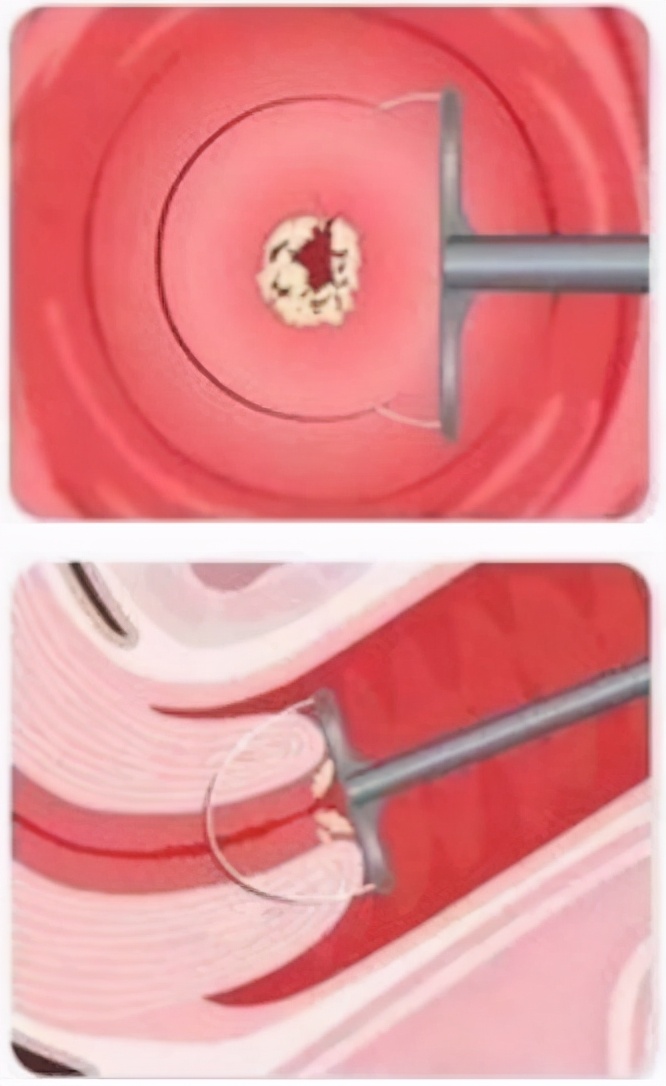 hpv高危52阳性持续2年未转阴,hpv持续感染3年多了不转阴怎么办