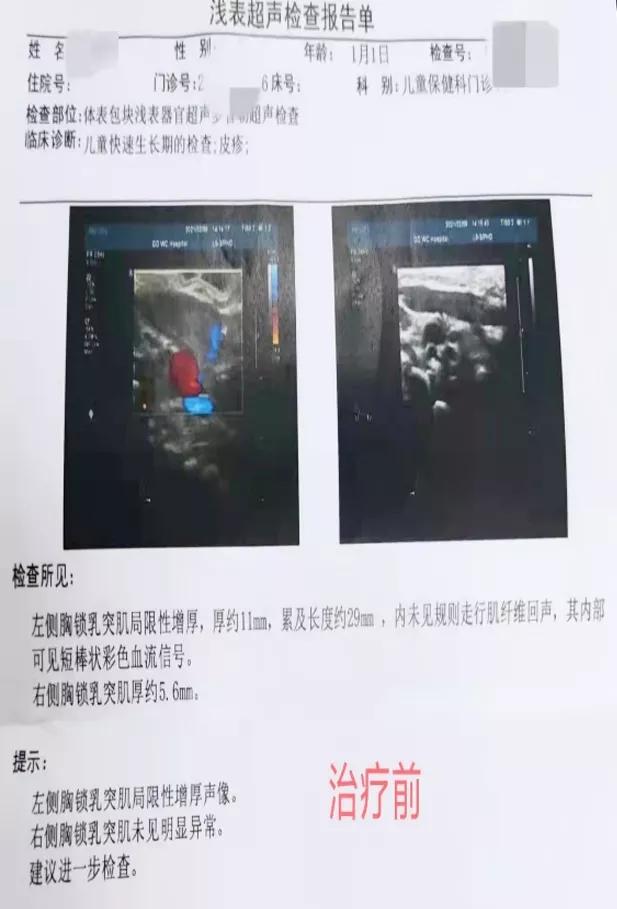 宝宝脖子歪向一边长大会自己好吗,小孩突然脖子歪一边痛什么原因