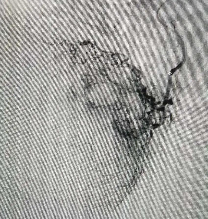 膀胱肿瘤患者吃什么保健品,膀胱肿瘤特效药