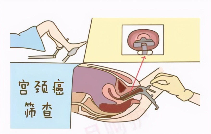 免费做两癌筛查的通知,免费做了两癌筛查医院要求复检