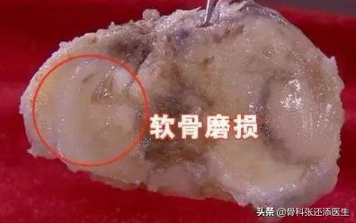 膝盖走路咯噔响还疼是什么原因,膝盖弯曲膝盖响是什么原因