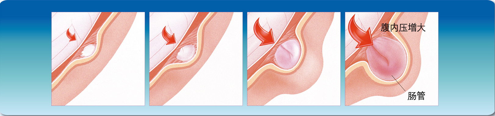 得了新冠小肠气痛,成年人得了小肠气手术大概几天好