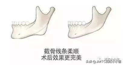 记录翻译小姐姐日本打溶脂针,肉脸变骨感脸全过程|日本医美