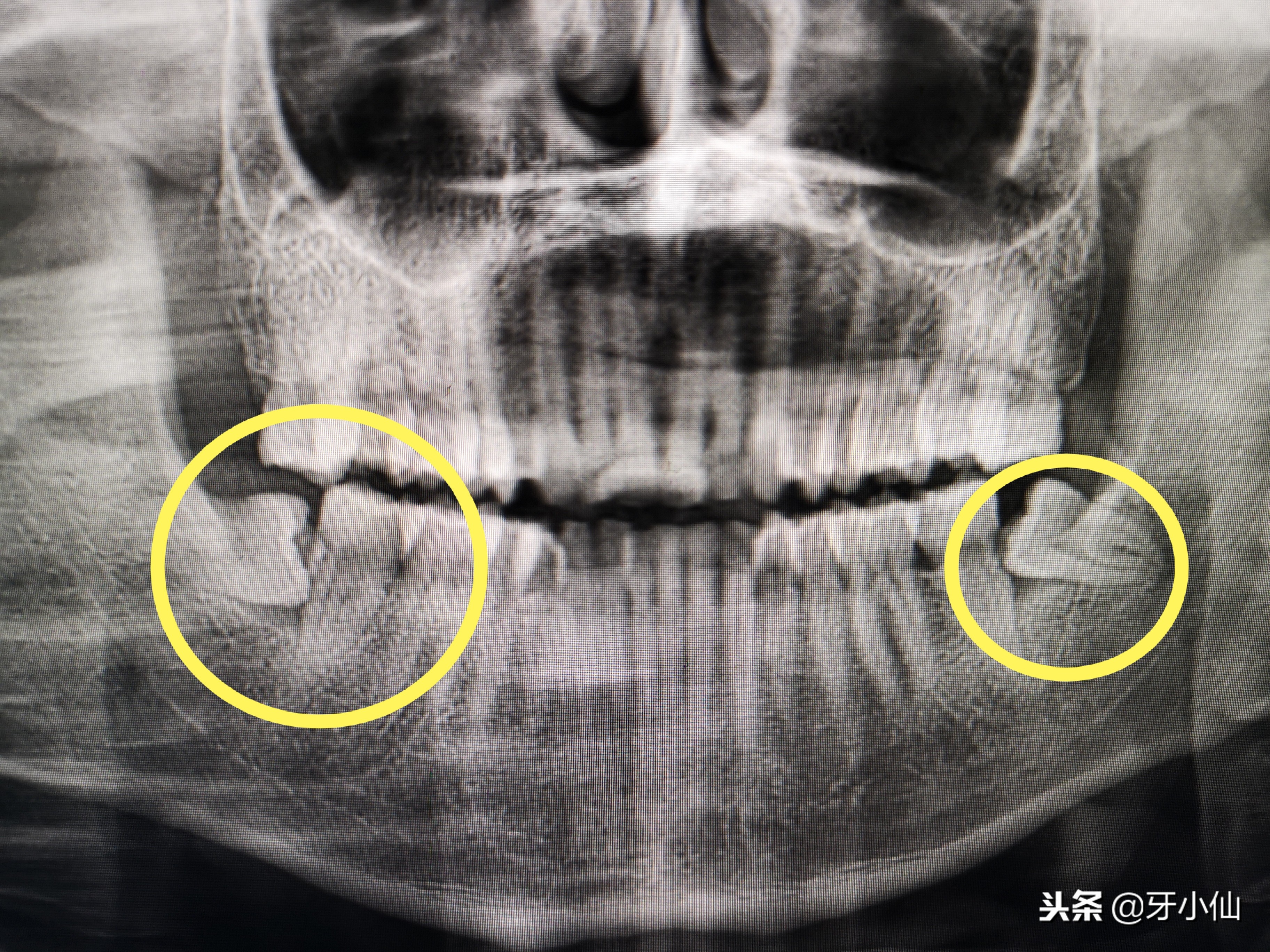 拔牙到底疼不疼几分钟能搞定,拔牙后很疼是伤到牙神经了吗