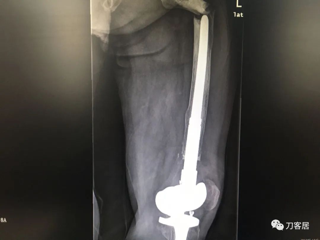 股骨胫骨骨折中医治疗方法,中药治疗股骨颈骨折