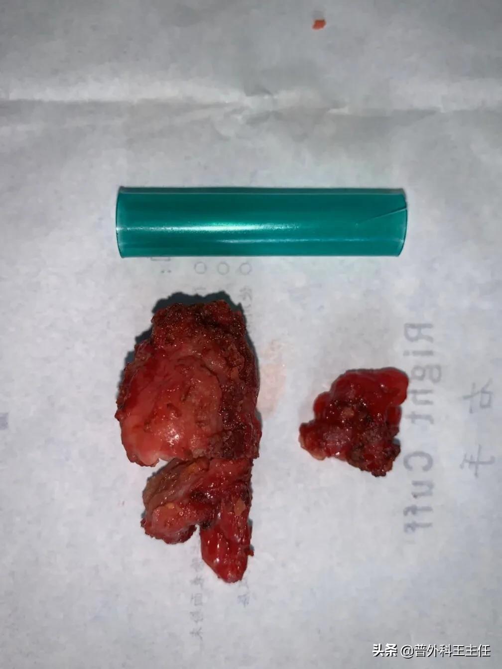 疝气注射疗法是治病还是致病？