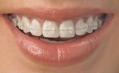 牙齿矫正有几种方式,牙齿矫正刷牙方式视频