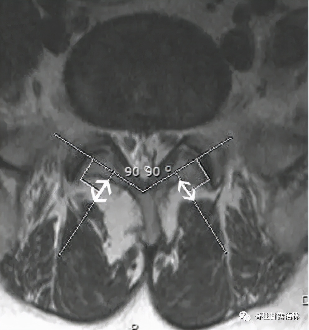 腰椎间盘突出中央型和旁侧型,腰椎间盘与椎板间隙的对应关系