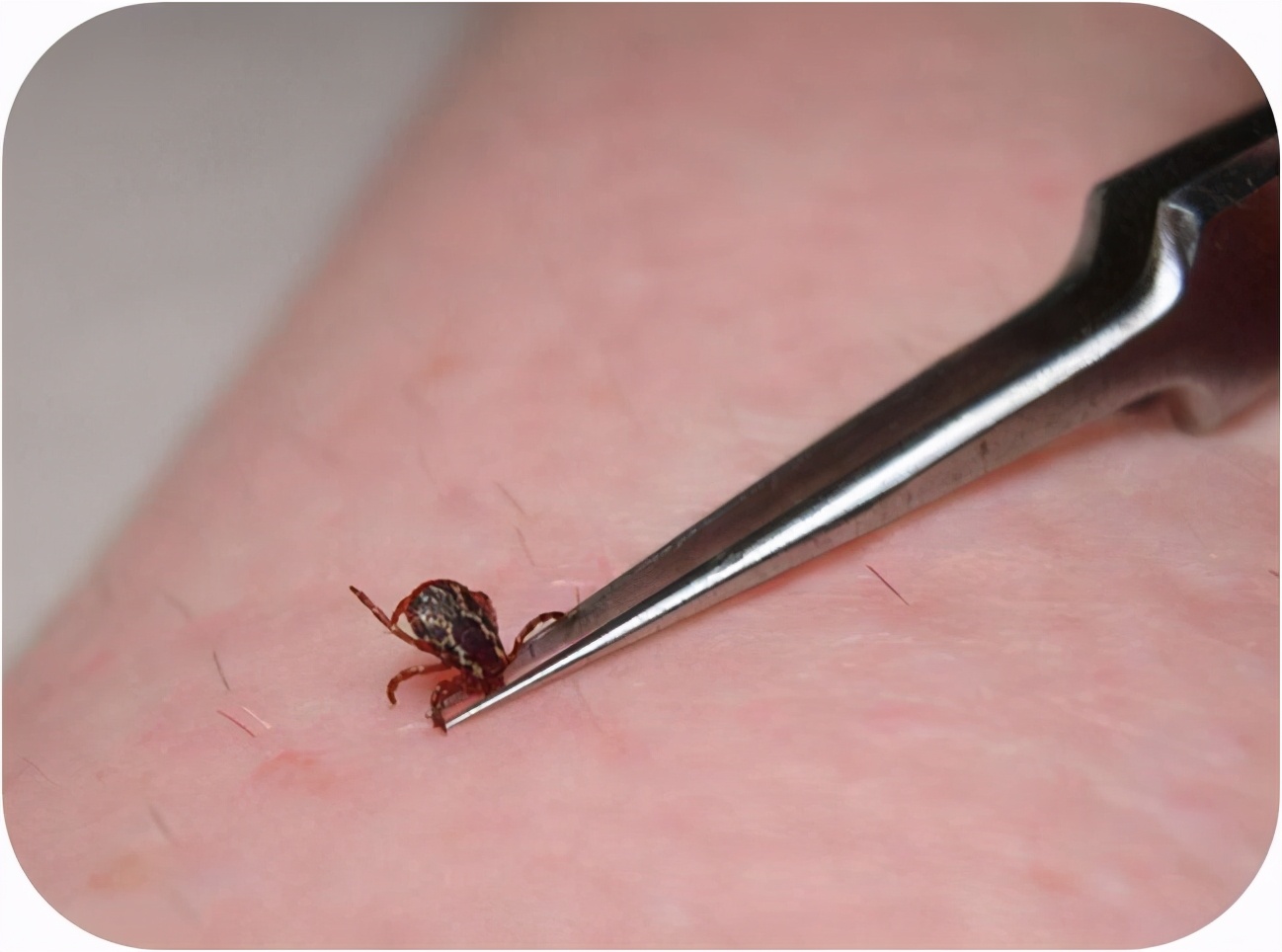 男孩被蚂蚁吓死,蚂蝗寄生在五岁男孩身体里一年