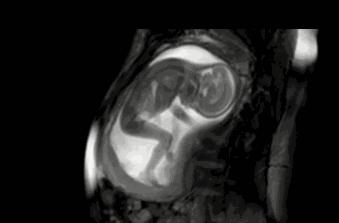 胎动辨宝宝状况,孕妇胎动频繁胎动信号很重要