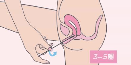 女人有没有性疾病查什么项目,宫颈癌的典型症状和筛查方法