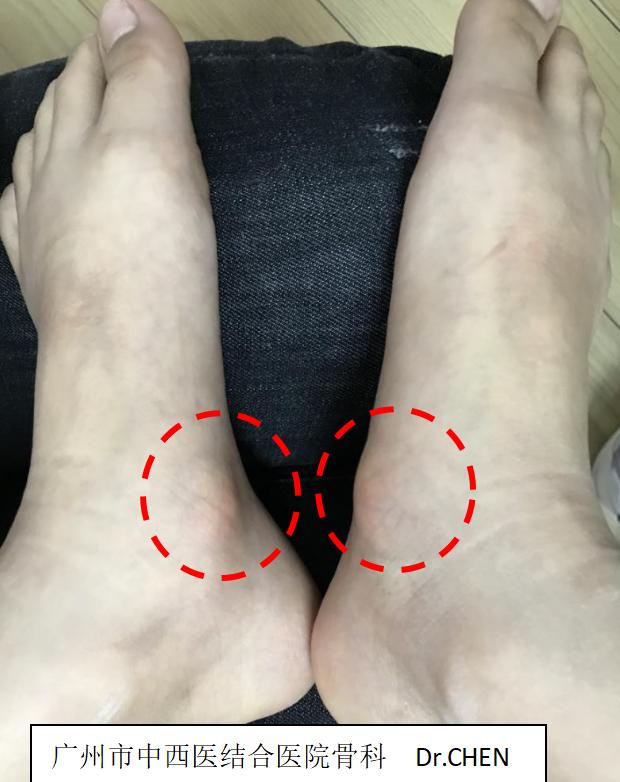 成人足副舟骨痛最佳解决方案,后天性扁平足导致副舟骨疼痛