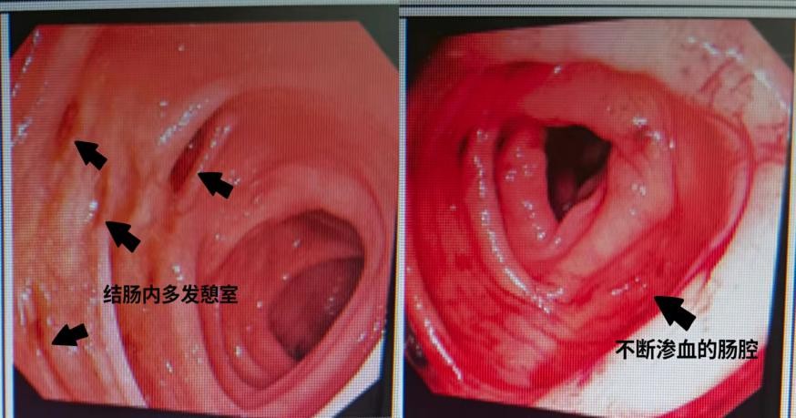 连续豪饮6天白酒后他的肠道数次“血崩”了