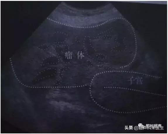 妇科常见疾病的超声诊断视频,超声常见疾病