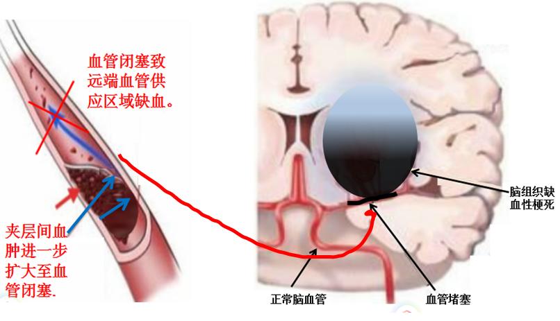 一个吻痕引起的致命性脑梗死事件，医生为你图说其中的机制