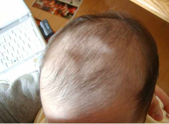 儿童脑袋中间凹下去是什么原因,小孩头顶凹下去一块是怎么回事