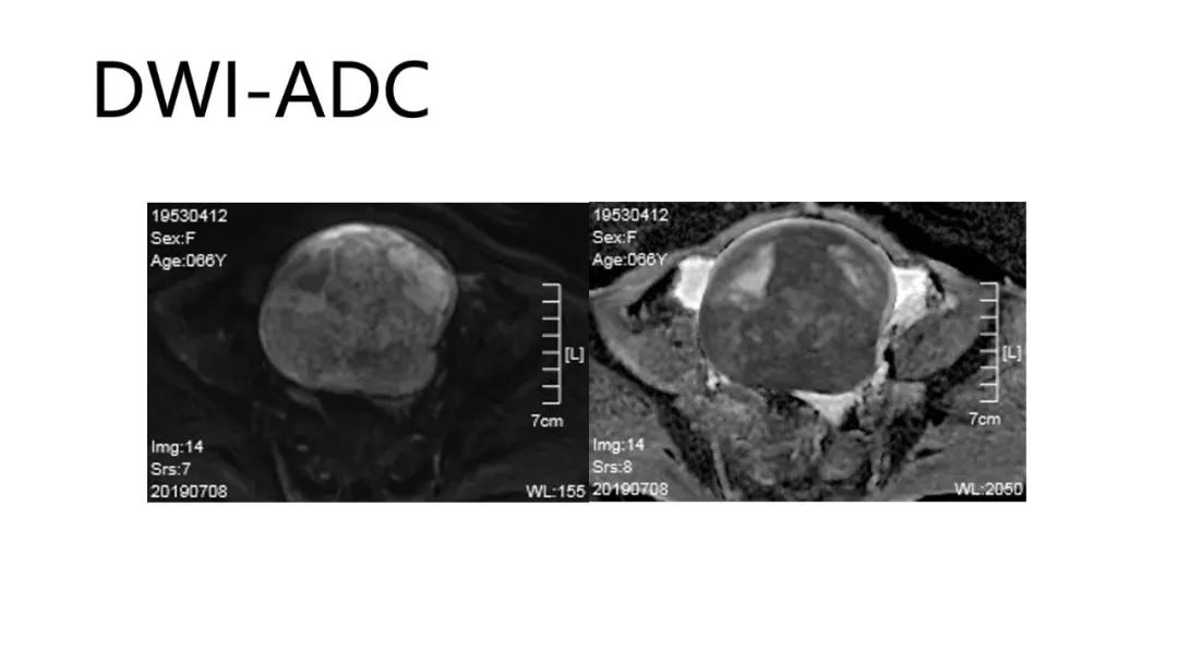 卵巢原发肿瘤的分析思路