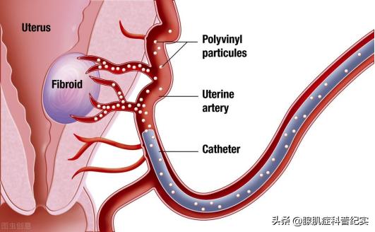 子宫腺肌瘤影响怀孕吗,子宫腺肌瘤和子宫肌瘤有什么区别