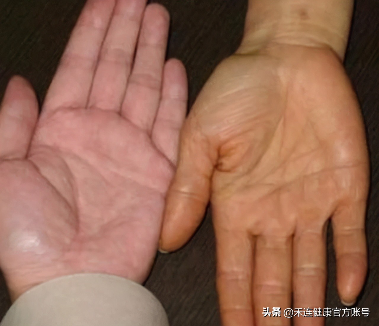 癌症肚子又胀又大是什么癌,什么癌症晚期症状是肚子变大