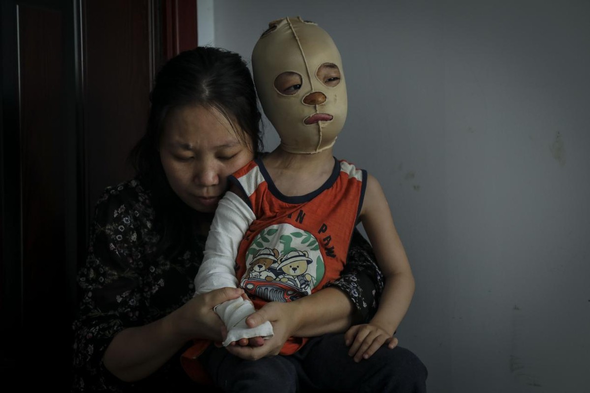 孩子被开水烫伤母亲却只心疼杯子,小孩掉进开水盆80%烫伤