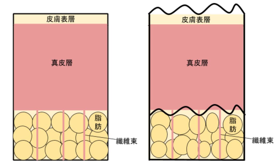 瘦下来橘皮会消失吗,橘皮组织肥胖怎么办