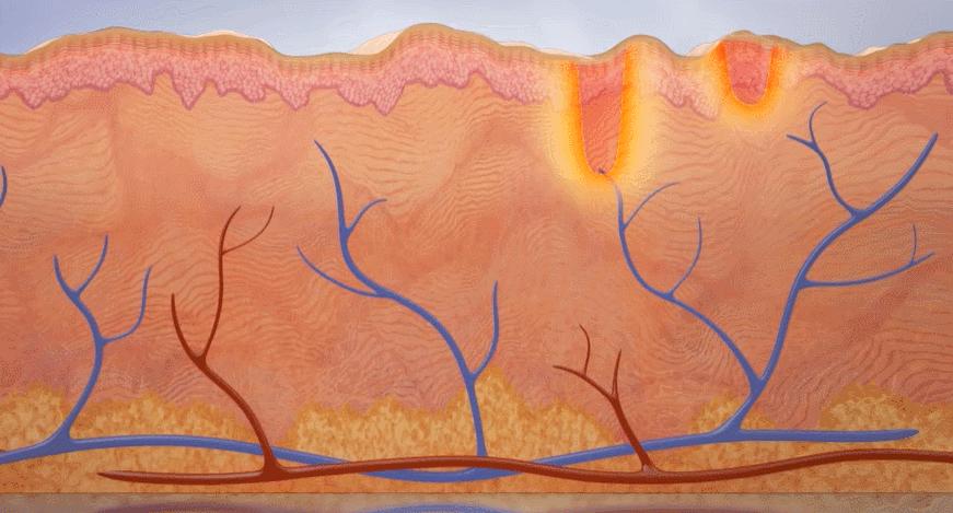 毛孔粗大怎么办教你一招收缩毛孔,毛孔粗大怎么办教你拯救方法