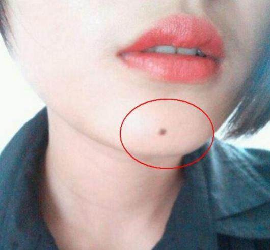 脸上多痣想祛除又怕留疤咋办,脸上切痣疤多久能消除