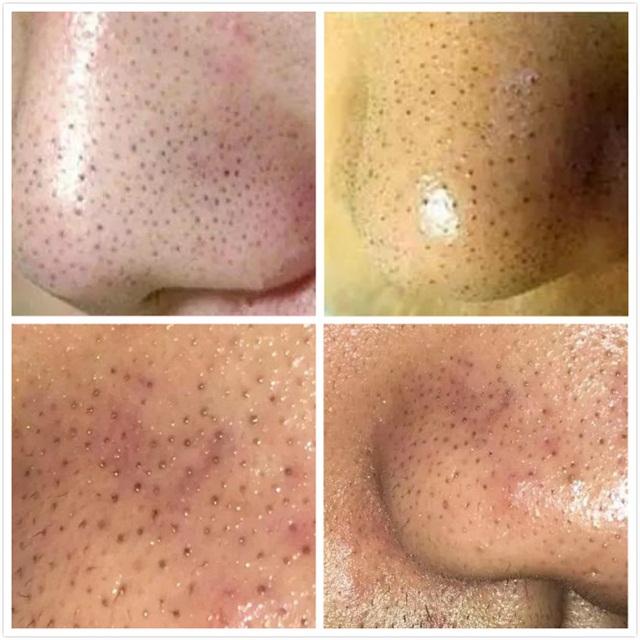 草莓鼻去黑头排行榜第一名,草莓鼻去黑头什么产品效果最佳