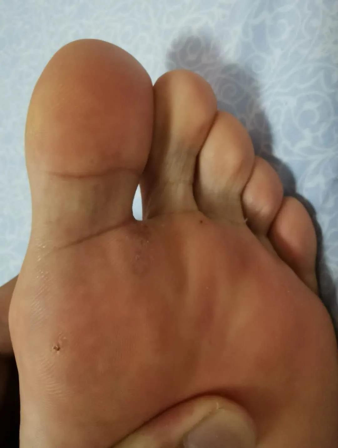 火针治疗跖疣有效果吗,火针点刺治疗跖疣