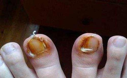 甲沟炎去修脚店要留指甲吗,脚指甲有甲沟炎怎么处理