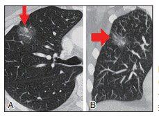 肺CT报告中的肺结节GGO是什么东西？到底是不是癌？