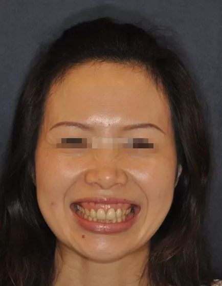 国家有关于牙齿的补贴吗,牙齿补贴报销政策