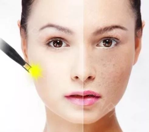 脸上有黑色素该怎么解决,有什么办法可以解决脸上的黑色素