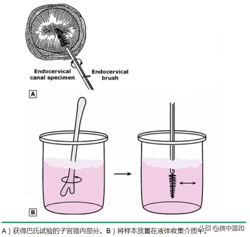 助人远离宫颈癌的“神器”—HPV检测和TCT检查,该怎么做?