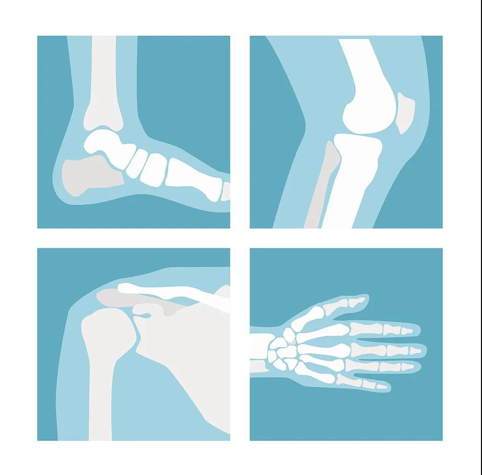 类风湿吃几个月药了风湿因子还高,风湿因子不高还会关节痛吗