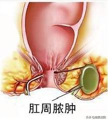 肛周脓肿小科普大知识,肛周脓肿科普知识