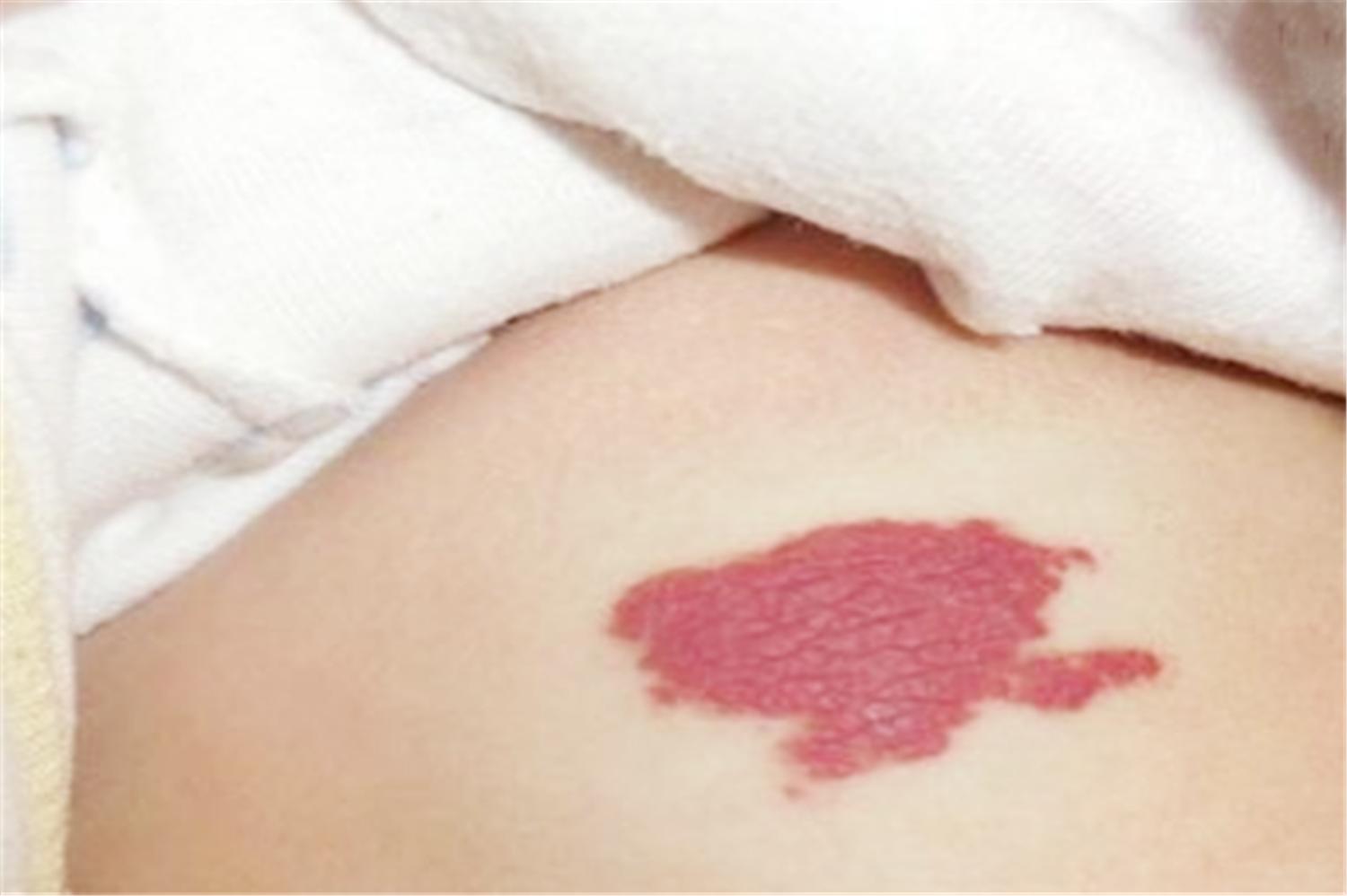 胎儿长胎记是怎么造成的,胎儿容易长胎记的原因是什么