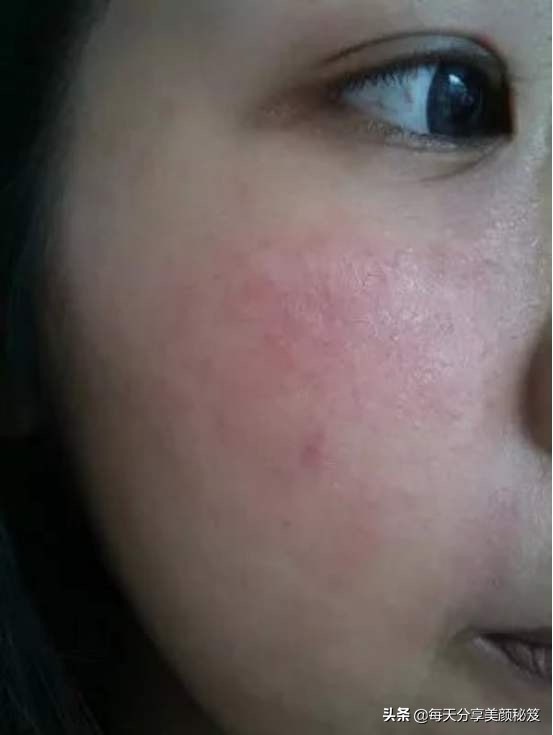 接触性皮炎用皮炎平有用吗,脸部接触性皮炎用什么药膏