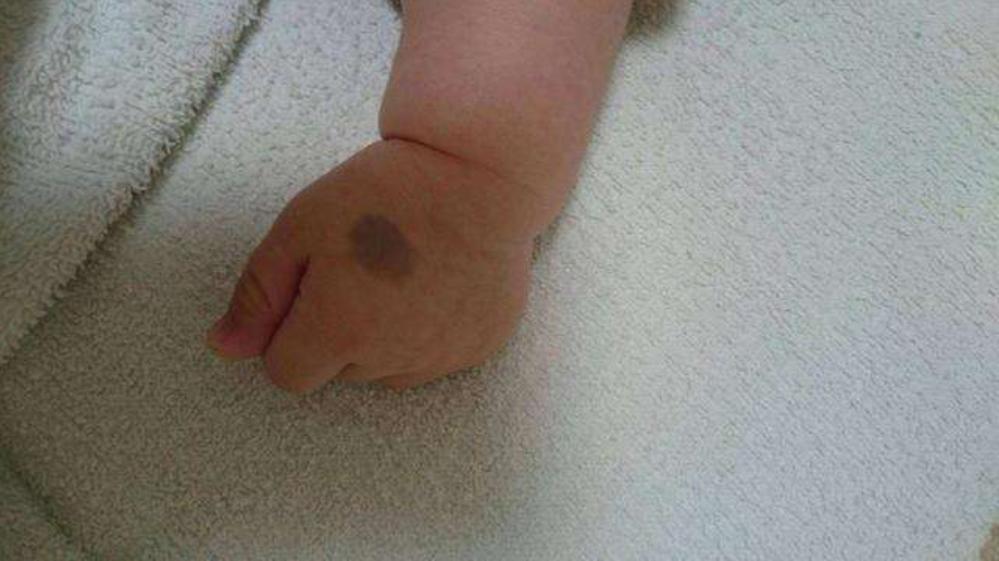 婴儿身上像有淤青一样的怎么回事,小婴儿身上有淤青是什么原因