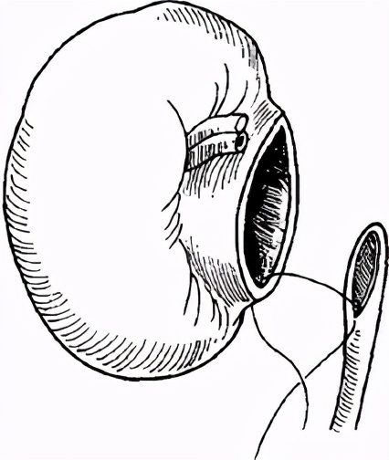 严重肾积水可以保守治疗吗,严重肾积水需要治疗吗