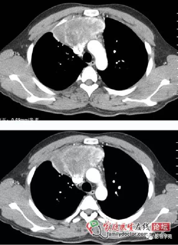 纵隔和肾上腺恶性肿瘤,纵隔性肿瘤位置图