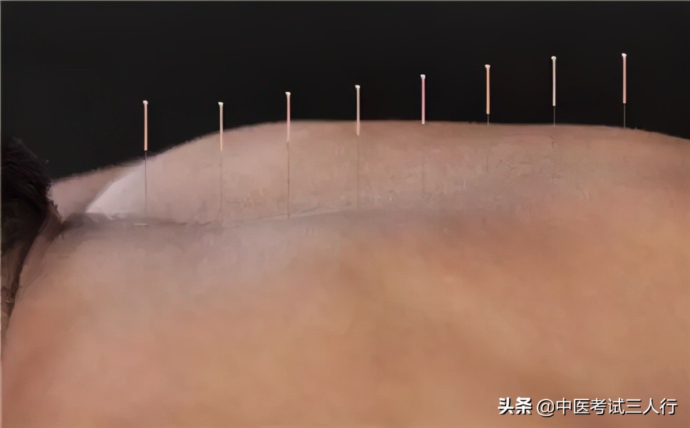 针灸减肥的最佳方法,针灸减肥40斤需要多久