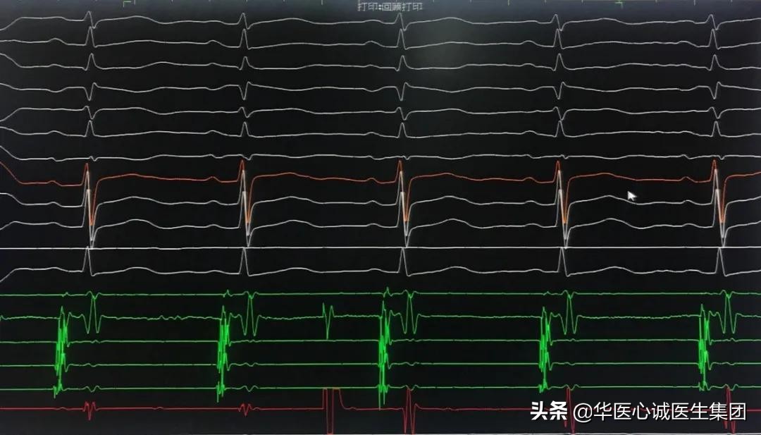 窦性心动过速查房,攀钢集团总医院心内科
