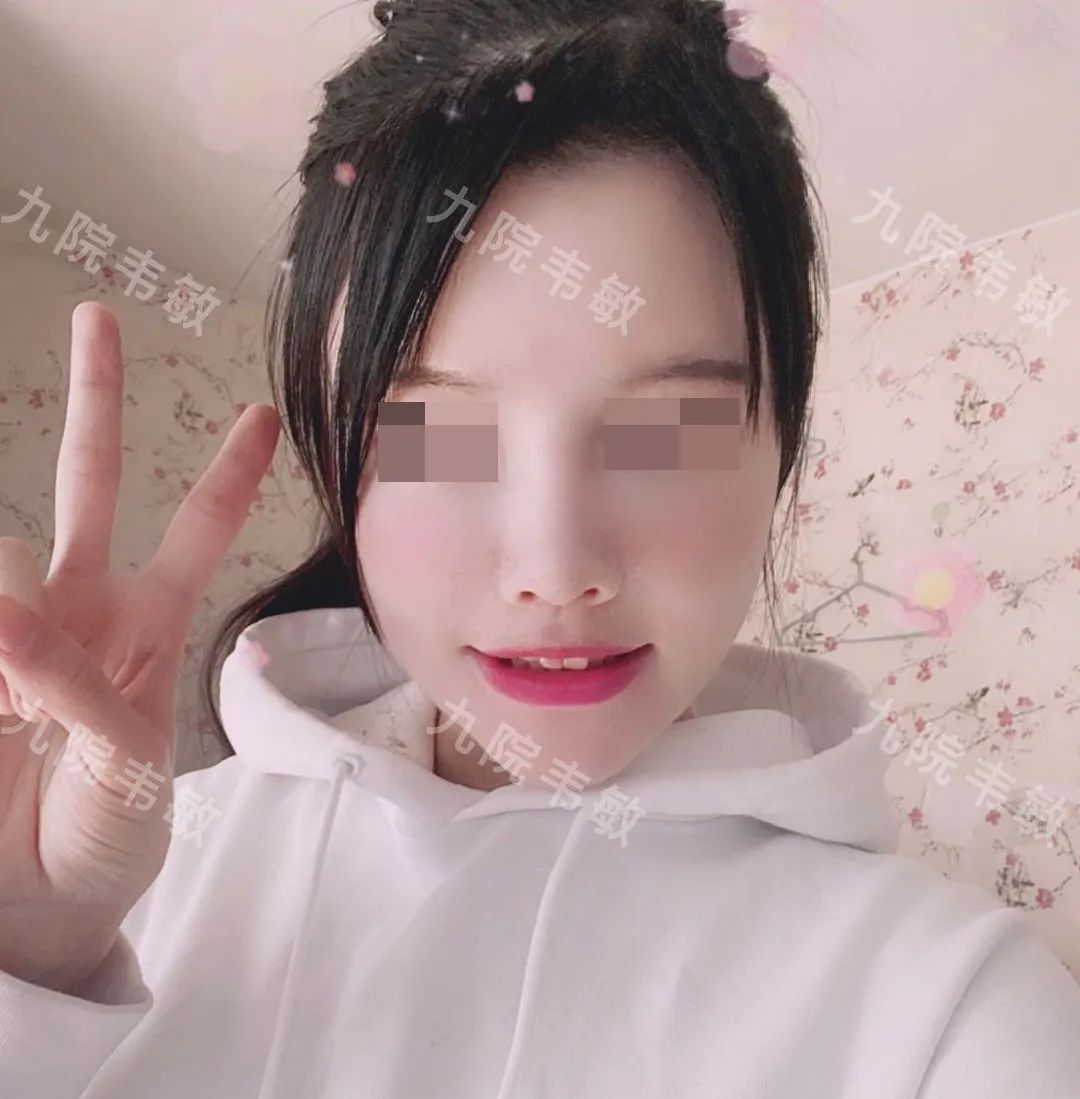 我终于摆脱了扁塌鼻这个颜值“拖油瓶”