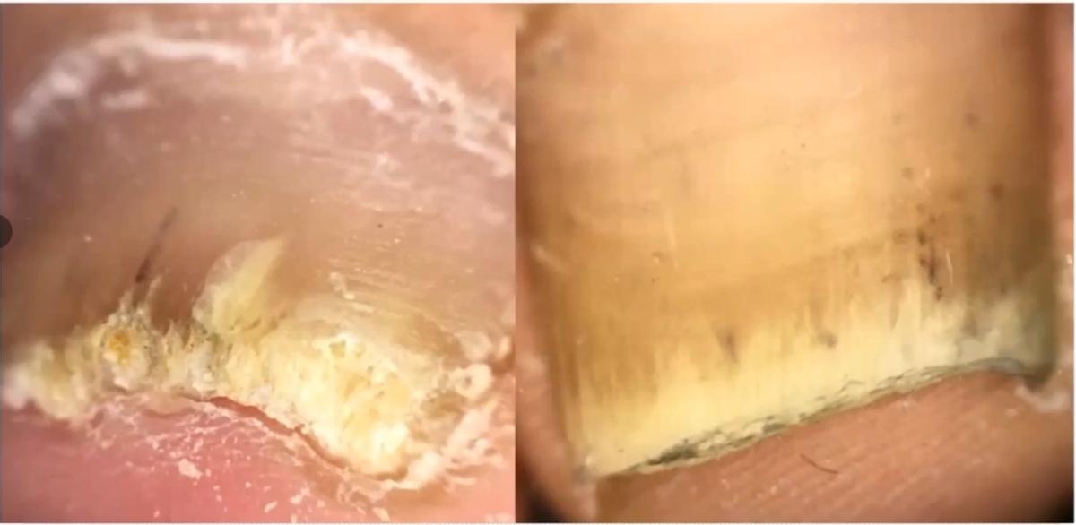 治灰指甲要验血吗,医院检查灰指甲挂号什么科